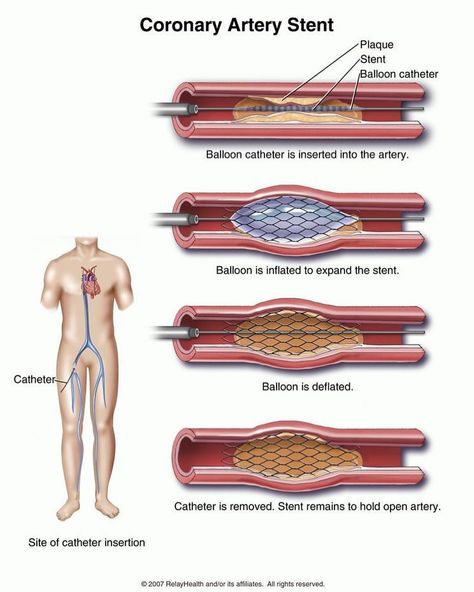 *CORONARY ARTERY STENT* . . A stent is a short, wire-mesh tube that acts like a scaffold to help keep your artery open. There are two main… Femoral Artery, Anatomy Of The Body, Cardiac Cath, Sistem Saraf, Vegetable Diet, Coronary Artery, Cardiac Nursing, Nursing School Survival, Surgical Tech