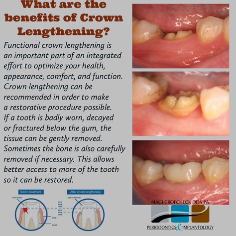 Functional crown lengthening is an important part of an integrated effort to optimize your health, appearance, comfort, and function. Crown lengthening can be recommended in order to make a restorative procedure possible. If a tooth is badly worn, decayed or fractured below the gum, the tissue can be gently removed. Sometimes the bone is also carefully removed if necessary. This allows better access to more of the tooth so it can be restored. Crown Tooth Repair, Crown Lengthening, Tooth Repair, Dental Crowns, Periodontal Disease, The Bone, Dental Implants, Health Issues, Gum