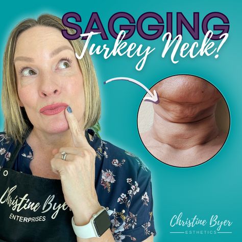 How To Tighten Turkey Neck, How To Fix Turkey Neck, Sagging Neck Remedies, Neck Lift Naturally, How To Get Rid Of A Turkey Neck, Neck Tightening Sagging Skin, Sagging Jowls Remedy, How To Get Rid Of Turkey Neck, Turkey Neck Exercises