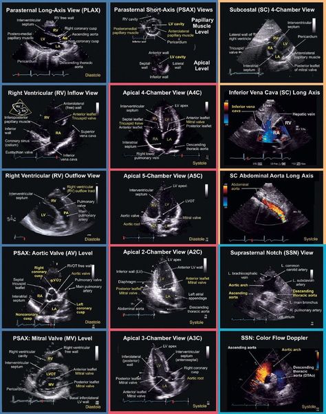 Check out this awesome infographic of echo views and anatomy! Thanks @HeartToProve Cardio Sonography, Diagnostic Medical Sonography Student, Ultrasound School, Cardiac Sonography, Sonography Student, Vascular Ultrasound, Ultrasound Sonography, Medical Ultrasound, Diagnostic Medical Sonography