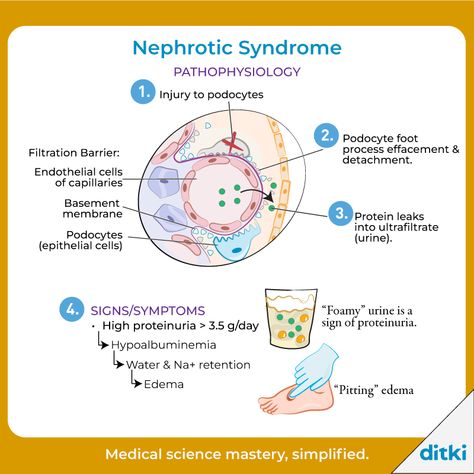 How do we diagnose Nephrotic Syndrome?  Learn more: https://ditki.com/course/pathology/glossary/term/nephrotic-syndrome-key-pathologies  #ditki #usmle #meded #medschool #medstudent #highered #mededonline #usmletutorials #pathology #nephroticsyndrome #renalpath #kidneypath #nursing #pance #physicianassistant #osteopath #allopath #medicine #science #healthscience #nurse #premed #mcat #mbbs Nephritic Syndrome, Focal Segmental Glomerulosclerosis, Glomerular Filtration, Pitting Edema, Clinical Pathology, Study Things, Basement Membrane, Nephrotic Syndrome, Pre Med