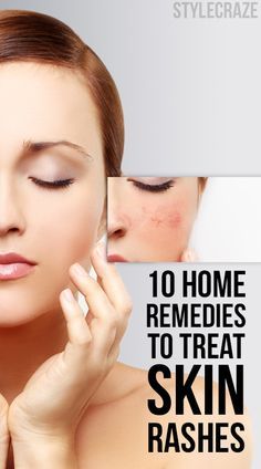 Heat Rash On Face, Face Rash Remedies, Skin Rash Remedies, Home Remedies For Rashes, Rash Remedies, Common Skin Rashes, Home Remedies For Face, Rash On Face, Rashes Remedies