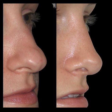 what is a bifid nasal tip ? Bulbous Tip Rhinoplasty, Tip Rhinoplasty, Suture Techniques, Bulbous Nose, Nose Jobs, Human Anatomy Reference, Rhinoplasty Before And After, Jason Bateman, Nose Job