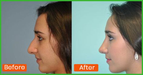 Sharp nose is a symbol of beauty and it fits in with any make up look too. Nose reshape exercises can help improve the shape! Here are top exercises for nose shape How Can I Make My Nose Smaller, How To Reshape Your Nose, Reshape Nose, Make Nose Smaller, Sharp Nose, Nose Types, Nose Reshaping, Nose Makeup, Face Tips