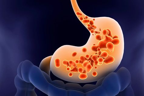 Get the Facts About Gastroesophageal Reflux Disease (GERD) Obese Pregnancy, What Is Gerd, Gerd Symptoms, Acid Indigestion, Reflux Symptoms, Reflux Disease, How To Get Thick, Stomach Acid, Scar Tissue