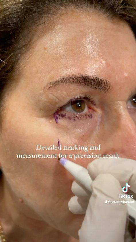 laradevganmd on Instagram: A closer look at finesse upper eyelid, lower eyelid, and temporal brow lift surgery. More videos on my TikTok 📐📐📐 #beautyisinthedetails… Lower Blephoraplasty Surgery, Blephoraplasty Surgery, Plastic Surgery Video, Brow Lift Surgery, Upper Eyelid, Brow Lift, Plastic Surgery, Instagram A, Surgery