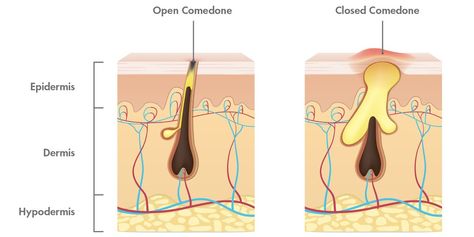 Open, Closed, WTH Are Comedones? | Hero Cosmetics How To Get Rid Of Closed Comedones, Closed Comedones, Comedonal Acne, Different Types Of Acne, Blind Pimple, Pore Strips, Skin Brushing, Types Of Acne, Get Rid Of Blackheads