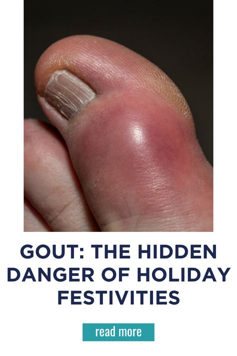 Gout: The Hidden Danger of Holiday Festivities Essential Oils For Swelling Inflammation, Uric Acid Crystals, Urinary Tract Infections (utis), Swollen Legs, Uric Acid, Foods And Drinks, Health Dinner, Foot Health, Back Pain Exercises