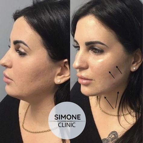 Jaw Filler, Soprano Ice Laser, Skincare Facts, Anti Wrinkle Injections, Cheek Fillers, Porcelain Skin, Nasolabial Folds, Nose Job, Anti Aging Tips