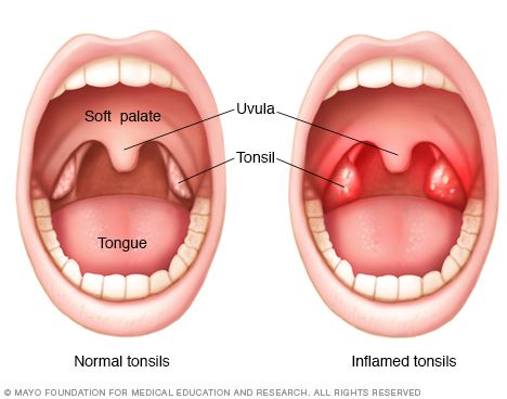 Inflamed tonsils Amla Juice, Immune Booster, How To Stop Snoring, Shiatsu Massage, Acupressure Points, Acupressure, Herbal Remedies, Ayurveda, Home Remedies