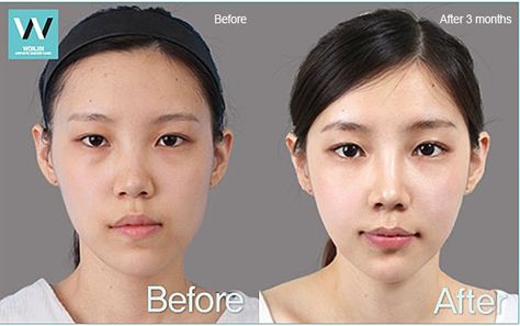 best plastic surgery clinic in korea: Facial asymmetry correction Before and After Plastic Surgery Korea Before After, Facial Asymmetry Correction, Facial Assymetry, Plastic Surgery Before And After, Face Asymmetry, Facial Asymmetry, Aesthetic Facial, Facelift Surgery, Plastic Surgery Clinic