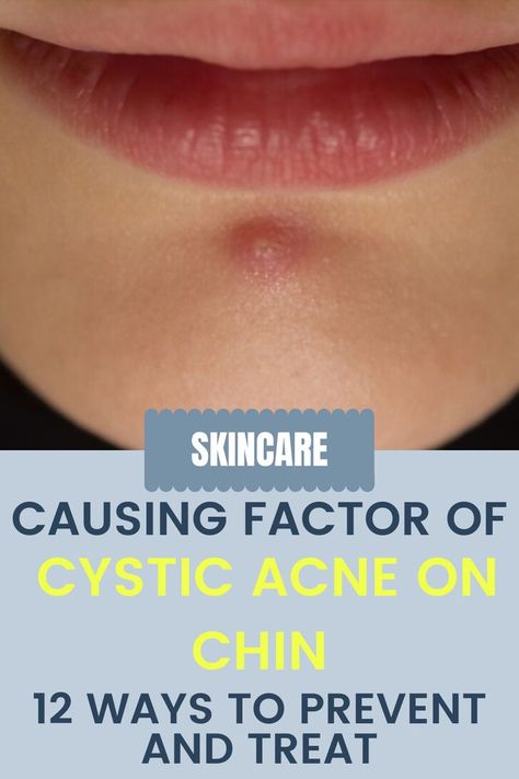 Causing Factor Of Cystic Acne On Chin - 12 Ways To Prevent And Treat Chin Breakouts, Chin Acne Causes, Cystic Acne On Chin, Painful Acne, Chin Acne, Cystic Pimple, Pimples On Face, Prevent Pimples, Acne Breakout