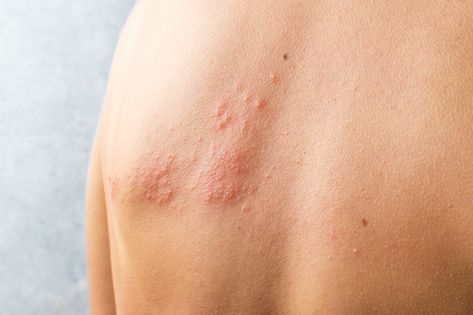 Treating Shingles with herbs and diet Treating Shingles, Nerve Pain, Acne Skin, Skin Care Tips, Healthy Skin, Diet, Skin, Health