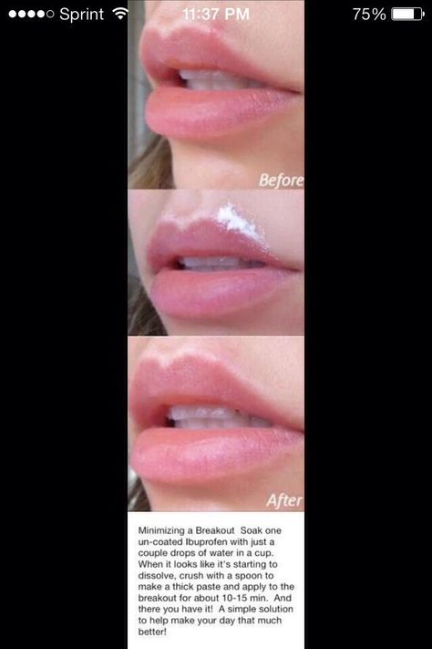 Lip Pimple, Cleopatra Beauty, Pimples On Forehead, Forehead Acne, Skin Care Center, Pimples Under The Skin, Natural Skincare Recipes, Antiaging Skincare Routine, How To Get Rid Of Pimples