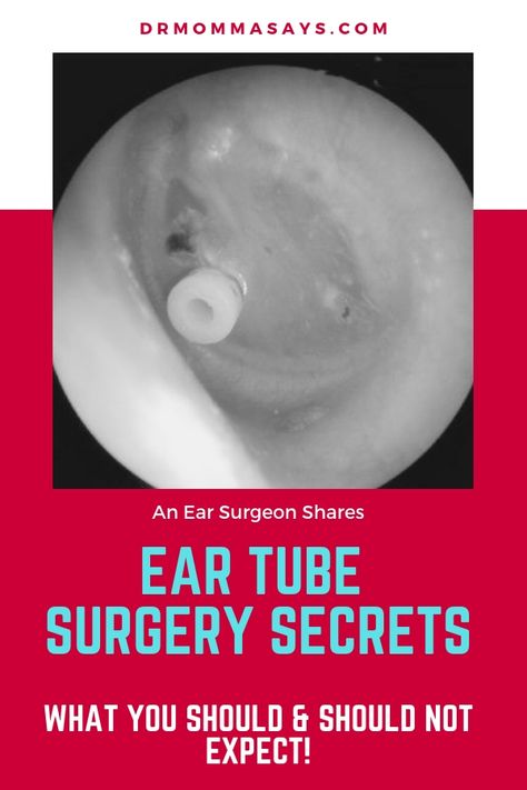 Ear Tube Surgery Secrets: What You Should and Should Not Expect - Dr Momma Says Ruptured Ear Drum, Fluid In Ears, Ear Tubes, Family Resources, Surgery Gift, Speech Delay, Toddler Stuff, Parenting Strategies, Family Ties