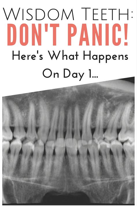 Wisdom Teeth: Don't Panic! Here's What Happens On Day 1 | www.thegingermarieblog.com Wisdom Teeth Removal Recovery, Wisdom Teeth Removal Food, Wisdom Teeth Video, Wisdom Teeth Food, Wisdom Teeth Pain Relief, Wisdom Teeth Recovery, Wisdom Teeth Pain, Tooth Pain Relief, After Wisdom Teeth Removal