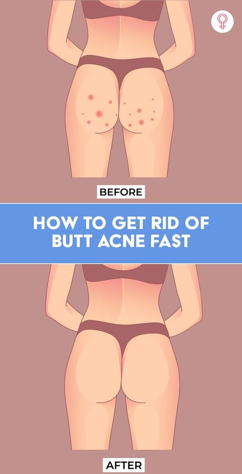 Buttocks Acne, Pimples On Buttocks, Back Acne Remedies, Pimples Remedies, Pimples On Face, Natural Acne Remedies, Resep Diet, Bumpy Skin, How To Get Rid Of Pimples