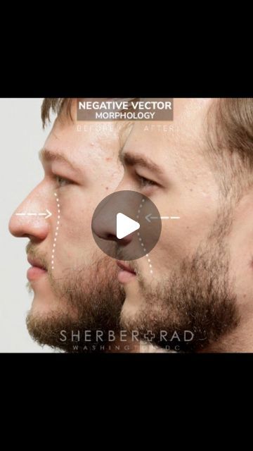 10K views · 3.2K likes | Ariel N. Rad, M.D., Ph.D., F.A.C.S. on Instagram: "Facial skeletal augmentation with implants are a big part of my practice. They’re important for people with a “negative vector” midface where the cheekbone sits behind the eyeball. These patients often present at young ages with under eye bags, dark circles, tear trough hollows and sagging cheeks which often create deep nasolabial folds (smile lines) and nasojugal (across cheek) grooves. 
••• 
Implants are made of porous polyethylene, a biocompatible material that integrates with the bone and soft tissues. It’s “porous” (microscopic holes and channels) is by design and allows vascular ingrowth into the implant thus reducing the chance of infection and becoming more “bone like”. So when you feel the implant over you Cheek Implants, Sagging Cheeks, Tear Trough, Smile Lines, Nasolabial Folds, Under Eye Bags, Skeletal, Eye Bags, Dark Circles