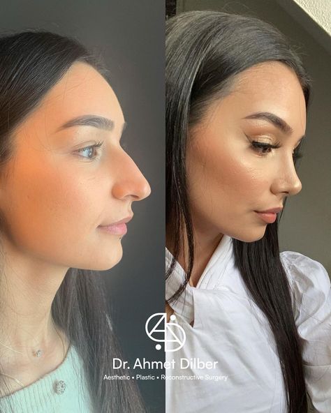 Jaw Reduction Surgery, Face Procedures, Plastic Surgery Fail, Rhinoplasty Nose Jobs, Face Surgery, Plastic Surgery Gone Wrong, Rhinoplasty Before And After, Cheek Fillers, Kylie Jenner Lipstick