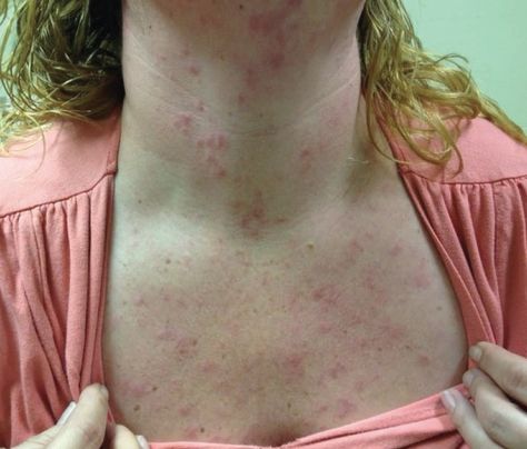 A 37-year-old woman had presented at the end of the summer with a pruritic rash, which had originally started on her neck then slowly progressed to the face, chest, shoulders, and arms. Groin Rash, Viral Rash, Home Remedies For Rashes, Fungal Rash, Body Rash, Rash On Face, Rash On Neck, Home Remedies For Allergies, Red Rash