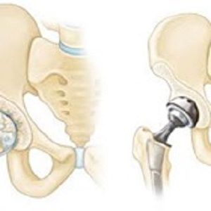 Most #hip replacement patients are able to walk within the same day or next day of #surgery; most can resume normal routine activities within the first 3 to 6 weeks of their total hip replacement recovery. Once light activity becomes possible, it's important to incorporate #healthy exercise into your recovery program. #hip_replacement #exercise Light Activities, Healthy Exercise, Nursing Care, Surgery