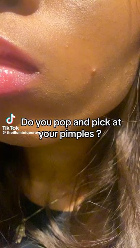 Get rid of pimples Pimple Hacks, Pimple Scar Removal, Getting Rid Of Scars, Regular Skin Care Routine, How To Clear Pimples, Forehead Acne, Get Rid Of Pimples, Rid Of Pimples, Pimple Scars