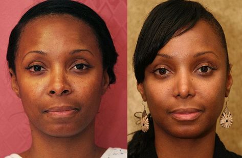 Ethnic Rhinoplasty, Yoga Training, Plastic Surgeon, Plastic Surgery, African American, Surgery