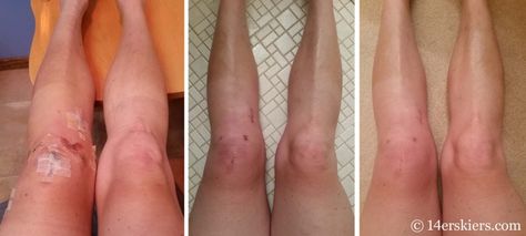 10 days, 3 weeks, and 6 weeks post-op for ACL/meniscus revision/repair Acl Recovery Timeline, Acl Aesthetic, Acl Surgery Recovery, Manual Muscle Testing, Meniscus Surgery, Acl Rehab, Acl Knee, Injection Sites, Knee Surgery Recovery