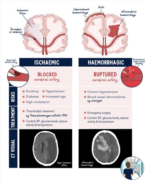 🧠 𝗤𝘂𝗶𝗰𝗸 𝗦𝘁𝗿𝗼𝗸𝗲 𝗢𝘃𝗲𝗿𝘃𝗶𝗲𝘄 🧠

Haemorrhagic 🆚 Ischaemic


#nursing #nursingnotes #nursingschool #nursingschoollife #nursingschoolnotes #registerednurse #LPN #ain #nurseeducator #stroke #ischaemicstroke #haemorrhagicstroke #studentnurse #studentnurses #thepreparednurseco Neuro Nursing, Concept Map Nursing, Neurology Nursing, Nursing School Studying Cheat Sheets, Nursing School Life, Nurse Skills, Nursing Skills, Science Cells, Medical Study