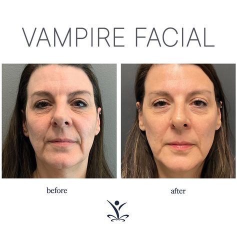 Vampire Facial Before And After, Prp Face Before And After, Plasma Pen Fibroblast Before And After, Fibroblast Plasma, Facial Before And After, Plasma Fibroblast, Platelet Rich Plasma Therapy, Vampire Facial, Platelet Rich Plasma