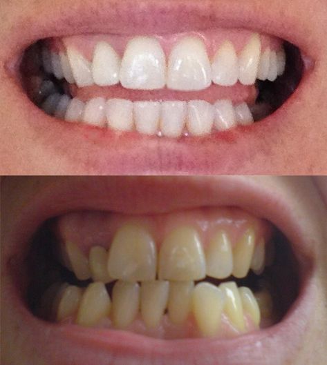 Teeth Before And After, Braces Before And After Glow Up, Invisalign Before And After, Teeth After Braces, Braces Before And After, Braces Colors Ideas, After Braces, Braces Pain, Invisalign Braces