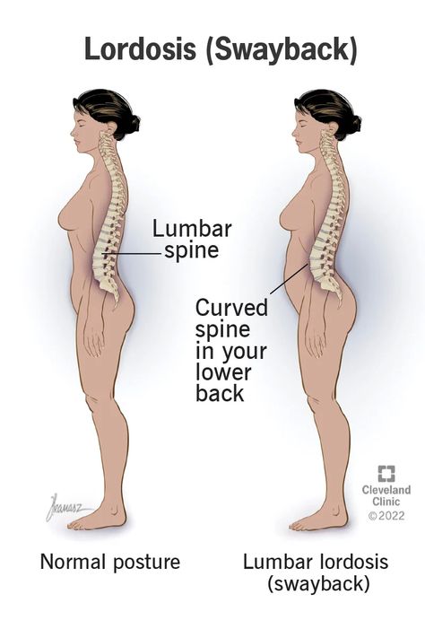 Lordosis (Swayback): Types, Causes & Symptoms Lumbar Lordosis, Back Acne Remedies, Bone Grafting, Piriformis Stretch, Low Estrogen Symptoms, Too Much Estrogen, Lower Back Pain Relief, Pregnancy Yoga, Cleveland Clinic