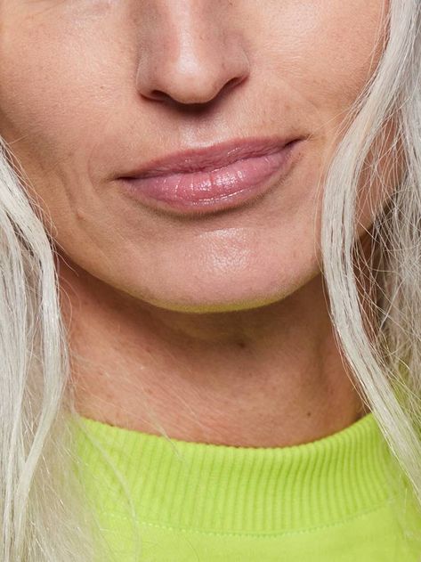 How to Get Rid of Lip Lines, According to Dermatologists | Who What Wear UK Rash On Face, Smokers Lines, Hyaluronic Acid Fillers, Lip Wrinkles, Lifestyle Habits, Upper Lip, Hyaluronic Acid Serum, Dermal Fillers, Broad Spectrum Sunscreen