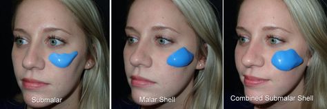 Cheek Implants Richmond VA | Facial Fillers | Midface Implants Cheek Implants Before And After, Cheek Implants, Chin Augmentation, Cheek Bones, Chin Implant, Silicone Implants, Tear Trough, Cheek Fillers, Facial Surgery