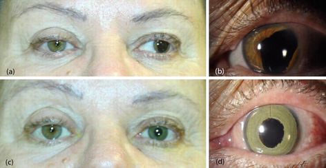 Eye Color Change Surgery, Laser Eye, Laser Surgery, Coloured Contact Lenses, Contact Lenses Colored, Colored Contacts, Cosmetic Surgery, Eye Color, Surgery