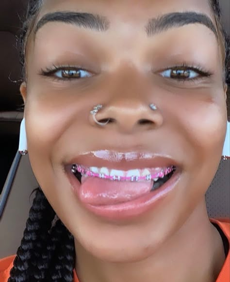 Braces Colors On Dark Skin, Rose Pink Braces, Braces Colors Pink, Pink Braces Aesthetic, Hot Pink Braces Teeth, Hot Pink And Light Pink Braces, Baby Pink Braces, Power Chain Braces Colors, Braces With Rubber Bands