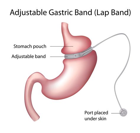 Lap Band, Gastric Band, Bariatric Surgeon, Sleeve Gastrectomy, Sleeve Surgery, Surgery Center, Hypnotherapy, Cosmetic Surgery, Reduce Weight