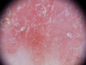 In situ squamous cell carcinoma images | DermNet Basel Cell Carcinoma Pictures, Sugar Foods, Squamous Cell, Skin Images, Low Sugar, Disease, New Zealand, Skin, Health