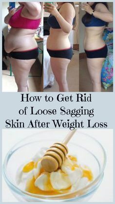 how-to-get-rid-of-loose-sagging-skin-after-weight-loss-1 Tighten Stomach, Skin Firming Lotion, Skin Tightening Stomach, Tighten Loose Skin, Skin Bumps, Saggy Skin, Diet Vegetarian, After Pictures, Loose Skin