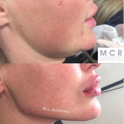 MCR Aesthetics on Instagram: “✨Jawline By MCR✨she’s done it again 📐💉🙌🙌✨Beautiful results once again ✨✨look at the definition & contour 😍😍that jawline 👌✨Mcr Aesthetics…” Jawline Surgery, Jawline Filler, Jawline Goals, Face Plastic Surgery, Nose Jobs, Rhinoplasty Nose Jobs, Facial Bones, Aesthetic Dermatology, Facial Fillers