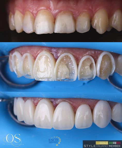 Dr.Osama Shaalan | Free hand palatal shell , unica frame before and after layering the veneering layer . Polished by lucida WDB composite ,SI2 + E +MP… | Instagram Composite Bonding Before And After, Veneers Before And After, Before And After, Face Plastic Surgery, Dental Photos, Composite Veneers, Tooth Filling, Dental Videos, Dental Photography