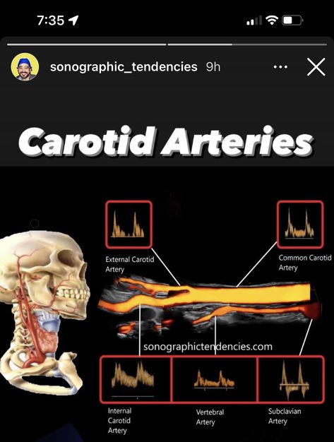 Carotid Artery Ultrasound, Carotid Ultrasound, Diagnostic Medical Sonography Student, Ultrasound School, Arteries Anatomy, Cardiac Sonography, Vascular Ultrasound, Sonography Student, Medical Sonography