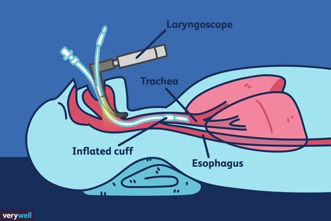 Learn what intubation is and why patients might need it after surgery or when recovering from a serious illness. General Anesthesia, General Anaesthesia, Pulmonary Disease, Serious Illness, Diagram Design, After Surgery, Health Advice, Medical Conditions, Pediatrics