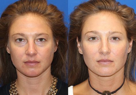 Fat Transfer Before & After Gallery Fat Grafting Face, Fat Transfer To Face, Breast Fat Transfer, Jaw Reduction Surgery, V Line Surgery, Aesthetic Procedures, Body Surgery, Plastic Surgery Fail, Korean Plastic Surgery