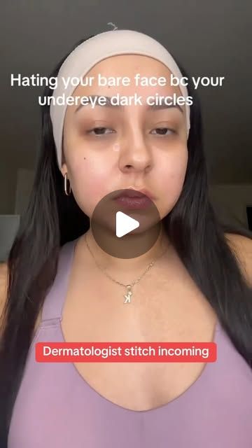 Dr. Neera Nathan on Instagram: "How to fade dark circles at home from a dermatologist.

There ARE affordable products that can improve dark undereye circles, but you will get the best results by picking a product that contains actives that target your type of dark circle.

Pigmented dark circles. These are often hereditary or genetic and common in people with deeper skin tones, but can be improved by using eye creams with brightening actives, like vitamin C, resorcinol, bakuchiol or glutathione (like Ole Henriksen Banana Bright Eye Cream, La Roche-Posay Pigmentclar Eyes, Tatcha The Brightening Eye Cream OR Andalou Naturals Rejuvenating Eye Balm). If you have pigmented dark circles, applying sunscreen under your eyes daily is critical to helping fade their appearance.

Vascular dark circles How To Get Rid Of Undereye Dark Circles, How To Remove Dark Eye Circles, Dark Undereyes How To Get Rid Of, Under Eye Pigmentation, Under Eye Brightener Diy, Removing Dark Circles Under Eyes, Undereye Darkness Remedy, Best Under Eye Cream For Dark Circles, How To Get Rid Of Dark Circles