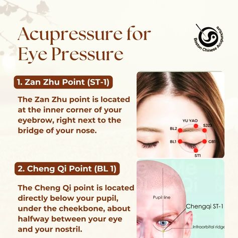 While acupressure is a traditional medicine technique gaining more scientific backing. However, acupressure can help with high eye pressure, like eye strain and headaches. Here are two acupressure points that may be helpful: 𝟭. 𝗭𝗮𝗻 𝗭𝗵𝘂 𝗣𝗼𝗶𝗻𝘁 (𝗦𝗧-𝟭) 𝐋𝐨𝐜𝐚𝐭𝐢𝐨𝐧: The Zan Zhu point is located at the inner corner of your eyebrow, right next to the bridge of your nose. 𝐇𝐨𝐰 𝐭𝐨 𝐦𝐚𝐬𝐬𝐚𝐠𝐞: Apply gentle pressure to this point with your thumb or index finger for 30 seconds to 1 minute. You can repeat thi... Eye Pressure Relief, Testosterone Injections, Eye Pressure, Acupuncture Clinic, Eye Pain, Laser Surgery, Eye Exercises, Eye Surgery, Acupuncture Points