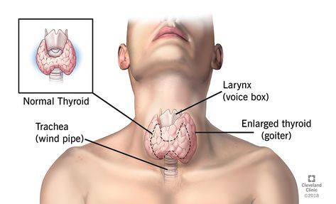 Difference Between Hashimotos and Hypothyroidism Overactive Thyroid, Hashimotos Disease, Dry Skin On Face, Thyroid Gland, Thyroid Hormone, Health Articles, Autoimmune Disease, Natural Remedies, Anatomy