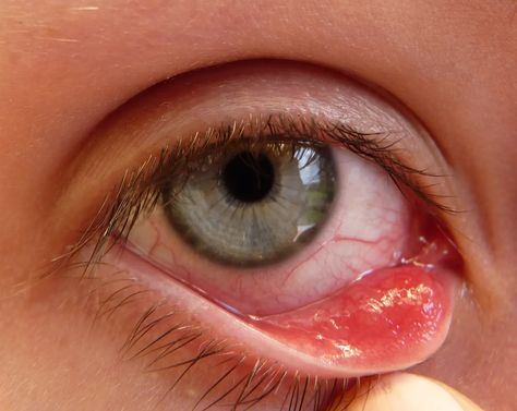 22 Home Remedies to Get Rid of Styes (With Photos) - RemedyGrove Get Rid Of Stye, Stye Remedies, Stye Remedy, Eye Stye Remedies, Alum Powder, Homeopathy Medicine, Canker Sore, Chamomile Oil, Formula Cans