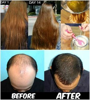 cc Hair Fall Control Tips, Hair Fall Remedy, Magical Hair, Thick Hair Remedies, Hair Growing Tips, Hair Regrowth Treatments, Hair Remedies For Growth, Home Remedies For Hair, Regrow Hair