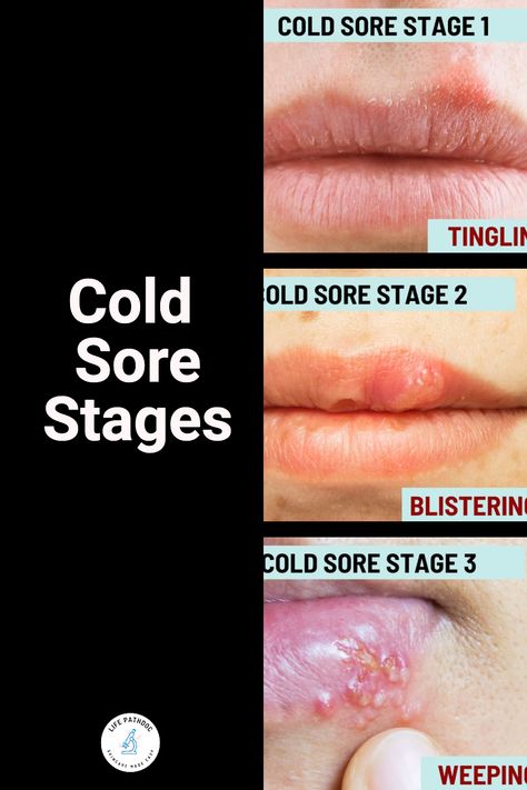 There are five stages of a cold sore outbreak, which include the early or beginning stage with tingling, the blister stage, the oozing or ulcer stage, the scabbing stage, and the healing stage. In this article, we will talk in-depth about the various stages of cold sores, their timeline in days, and their progression. With each cold sore stage, you will find pictures depicting the healing process of cold sores. How To Heal A Cold Sore Fast, How To Get Rid Of Cold Sores, How To Get Rid Of Cold Sores Overnight, Fever Blister Remedy Fast, Cold Sore Scab, Heal Cold Sores Fast, Cold Sore Remedy Overnight, Stages Of A Cold, Fever Blister Remedy